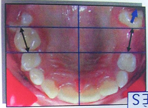 Extraction temporaire